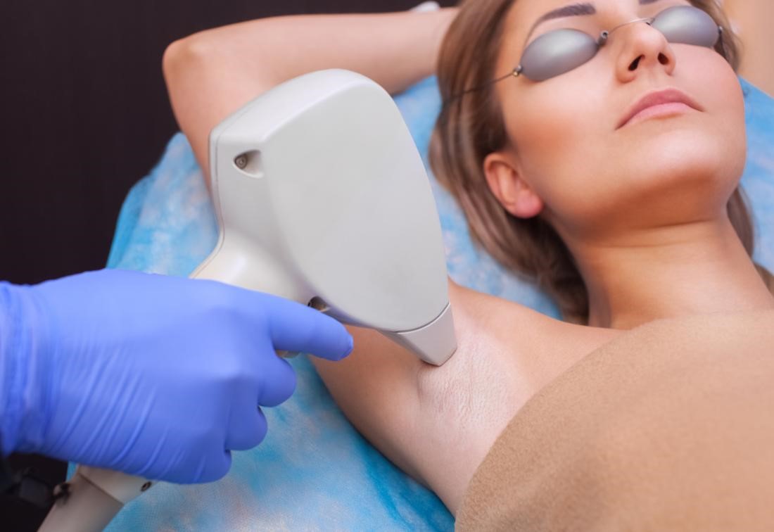 What are 5 Essential Things to Consider Before Having Laser Hair Removal?